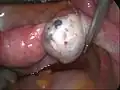 Endometriose des rechten Eierstocks