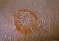 Tinea corporis am Arm