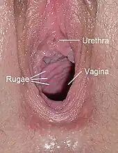 Blick in das vordere Drittel der Vagina, mit typischen Querfalten (Rugae vaginales); oberhalb die Harnröhrenmündung (Carina urethralis vaginae)