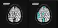 Axiales SWI-Bild der scheitelnahen Duravenen. Die Thrombose ist im rechten Bild blau hervorgehoben.