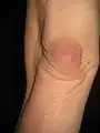 Bursitis am Ellbogen, völlig schmerzfrei, nur ein Spannungsgefühl beim Beugen