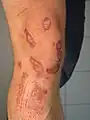 Kreisrunde Schürfwunde am Knie