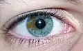 Iris mit lokaler Pigmentstörung(sog. „sektorielle Heterochromie“)