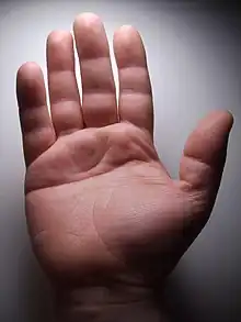 Vierfingerfurche beim Menschen