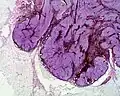 Histologie eines Blauen Nävus, Naevus coeruleus cellularis (2×)