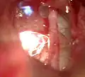 Laserschuss auf die Fußplatte