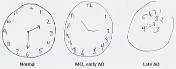 Links: Uhrenzeichnung einer gesunden Kontrollperson Mitte: Betroffene in der Frühphase. Die Grundstruktur der Uhr ist noch zu erkennen, die Stunden jedoch nicht mehr gleichmäßig verteilt. Rechts: Verworrenes Bild, der äußere Ring der Uhr ist nicht mehr geschlossen, die Zahlen wahllos in der Mitte des Ziffernblatts positioniert.