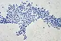 Feinnadelbiopsie eines Adenoms