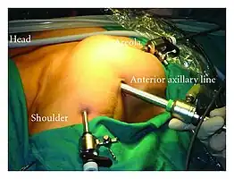 Im Vergleich dazu eine minimalinvasive rechtsseitige Lobektomie der Schilddrüse.