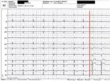 unauffälliges Ruhe-EKG mit einsetzendem Linksschenkelblock
