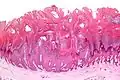 Viruswarze, histologisch