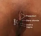 Glans clitoridis mit kleinem Abstand zur Öffnung
