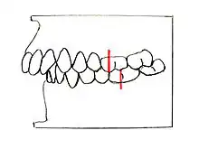 Angle-Klasse II/1